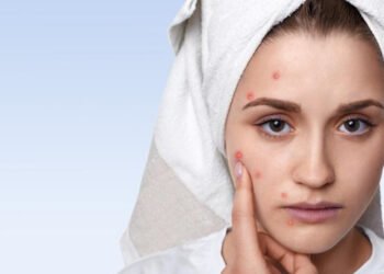 मुहांसे वाली त्वचा है? तो तो यूं करें मेकअप