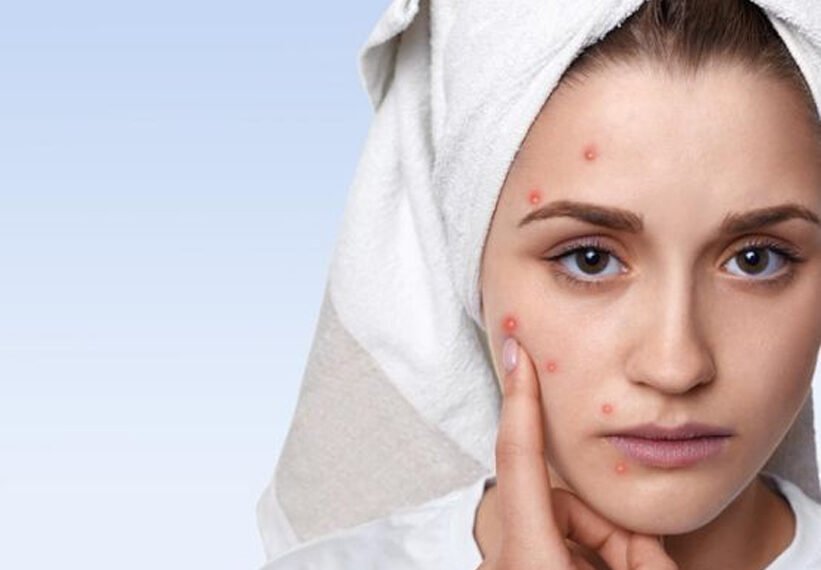 मुहांसे वाली त्वचा है? तो तो यूं करें मेकअप