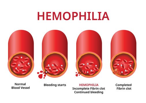 Hemophilia_in-hindi