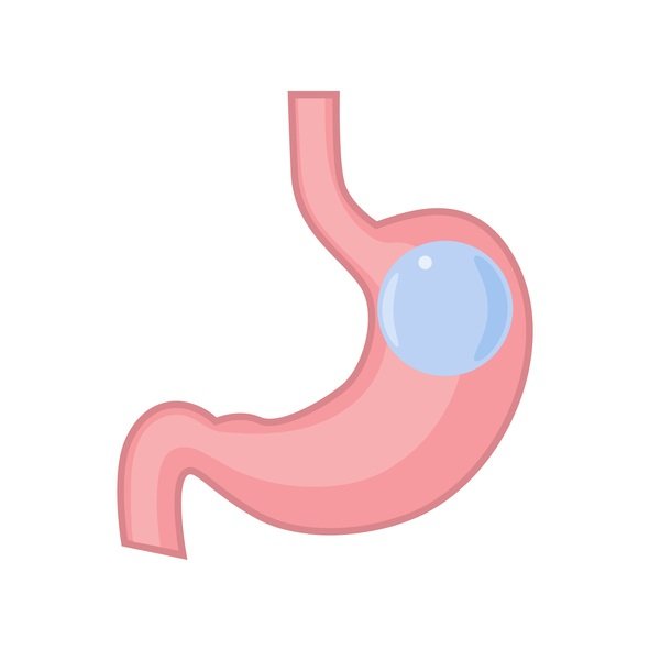 Gastric-Baloon